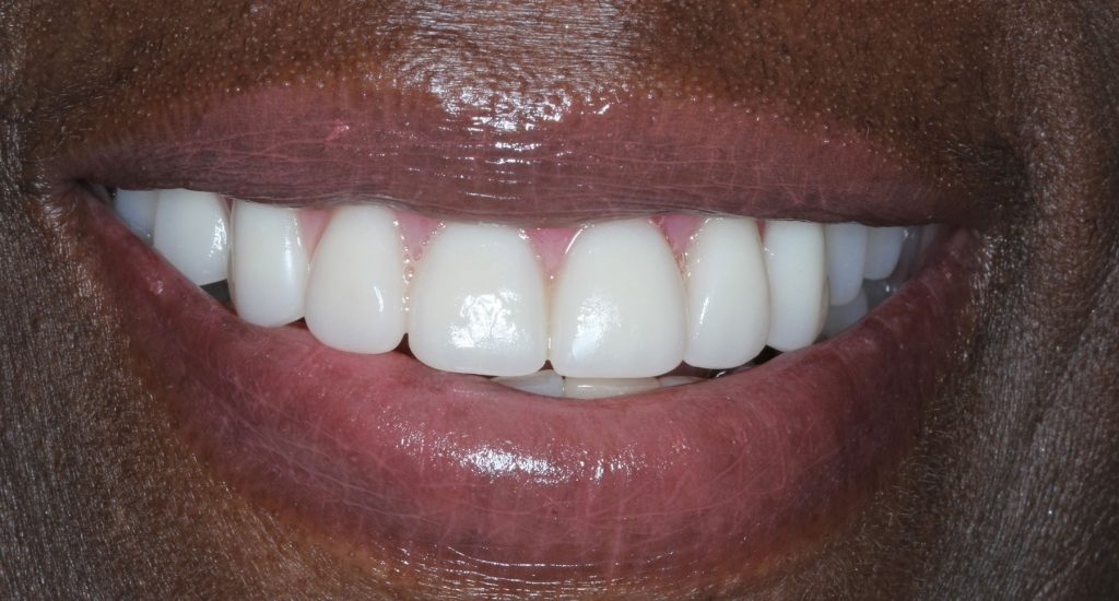 A female patient after cosmetic dentistry in Alexandria.