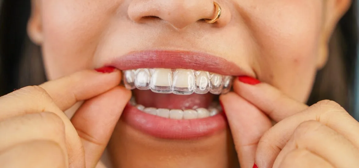 Young Asian Indian woman holding removable invisible aligner, also known as invisalign