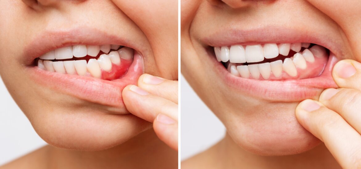 side by side picture showing gum disease progression