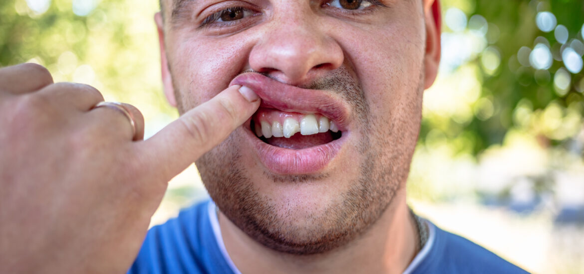 man in blue shirt exposing his chipped tooth