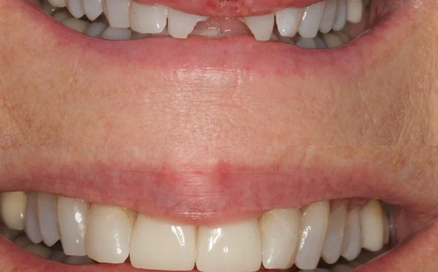An Alexandria patient with tooth damage before and after dental crowns.
