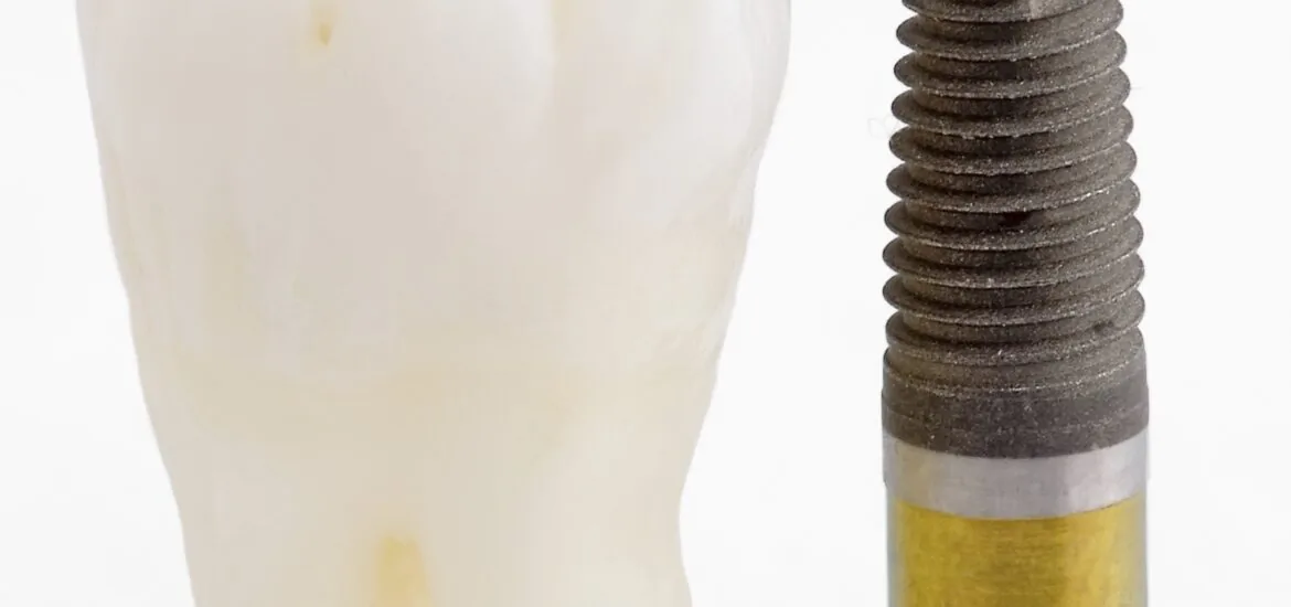 A tooth and an implant, results of untreated gum disease in Alexandria.